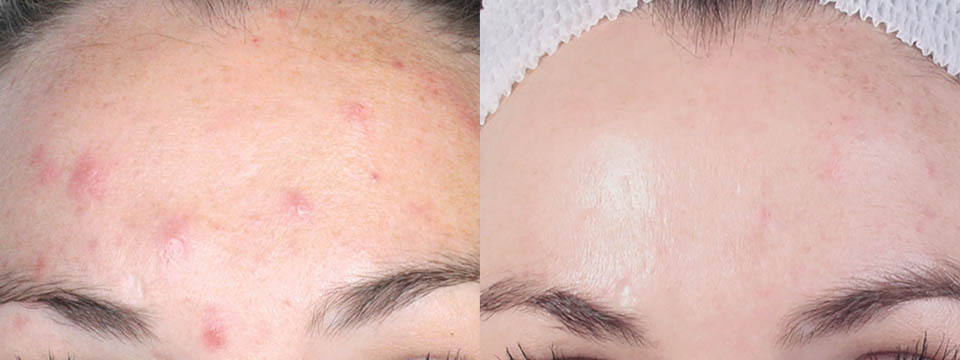 acne-scar-removal-gilbert-ba1
