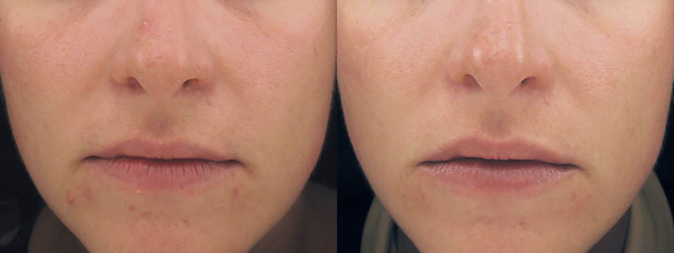acne-scar-removal-gilbert-ba2