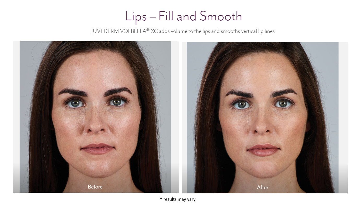 Look Younger Instantly With Juvederm At Skinovative Gilbert Med Spa
