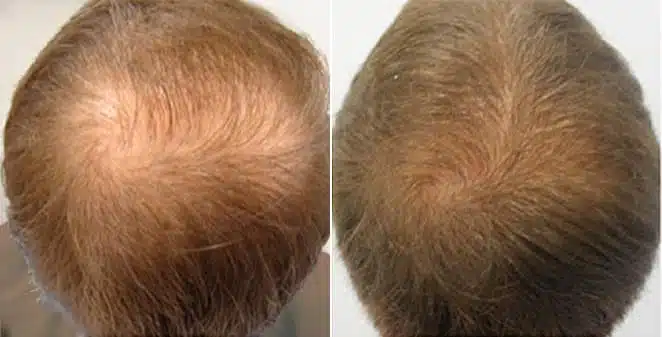 meso-hair-dht-blocking-mesotherapy-dutasteride-arizona