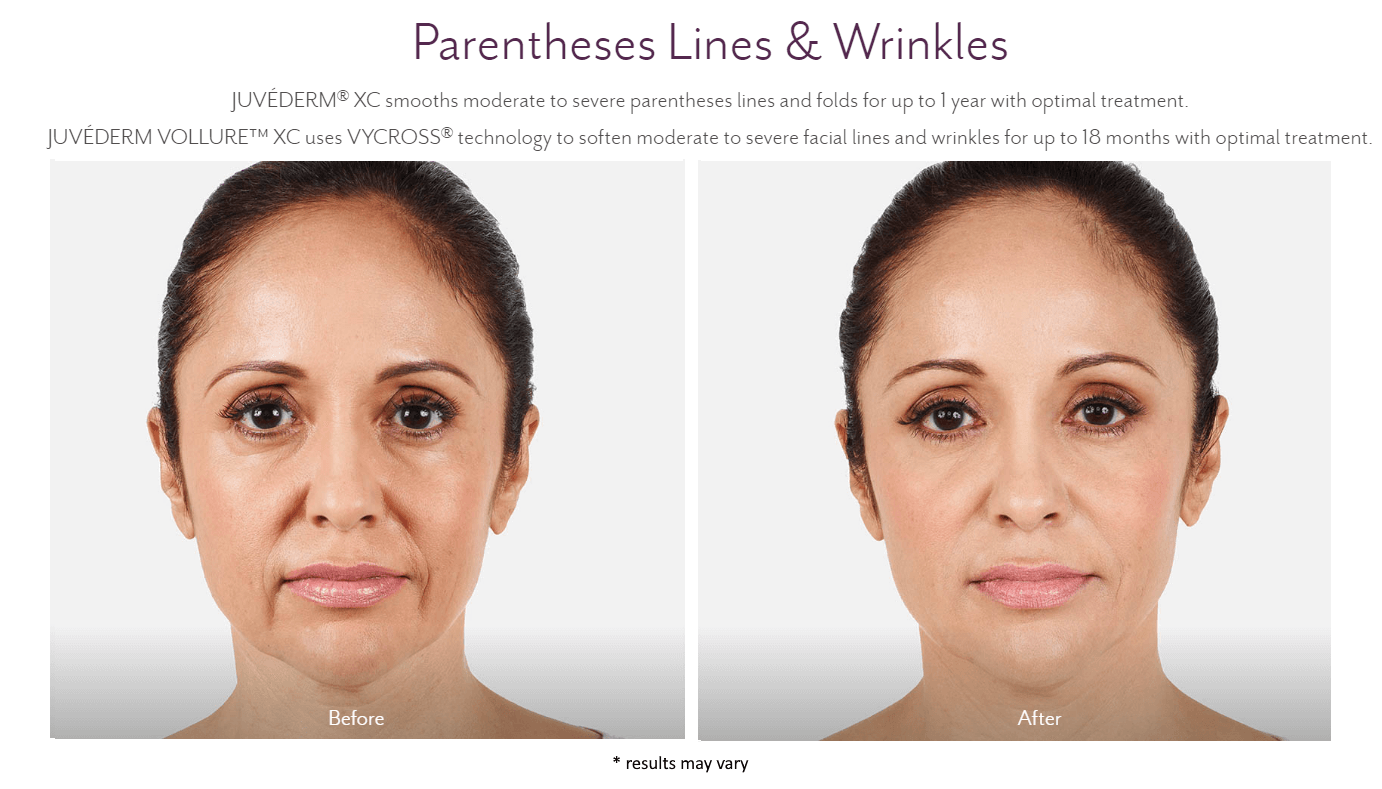 new-beauty-wellness-juvederm-before-and-after-2
