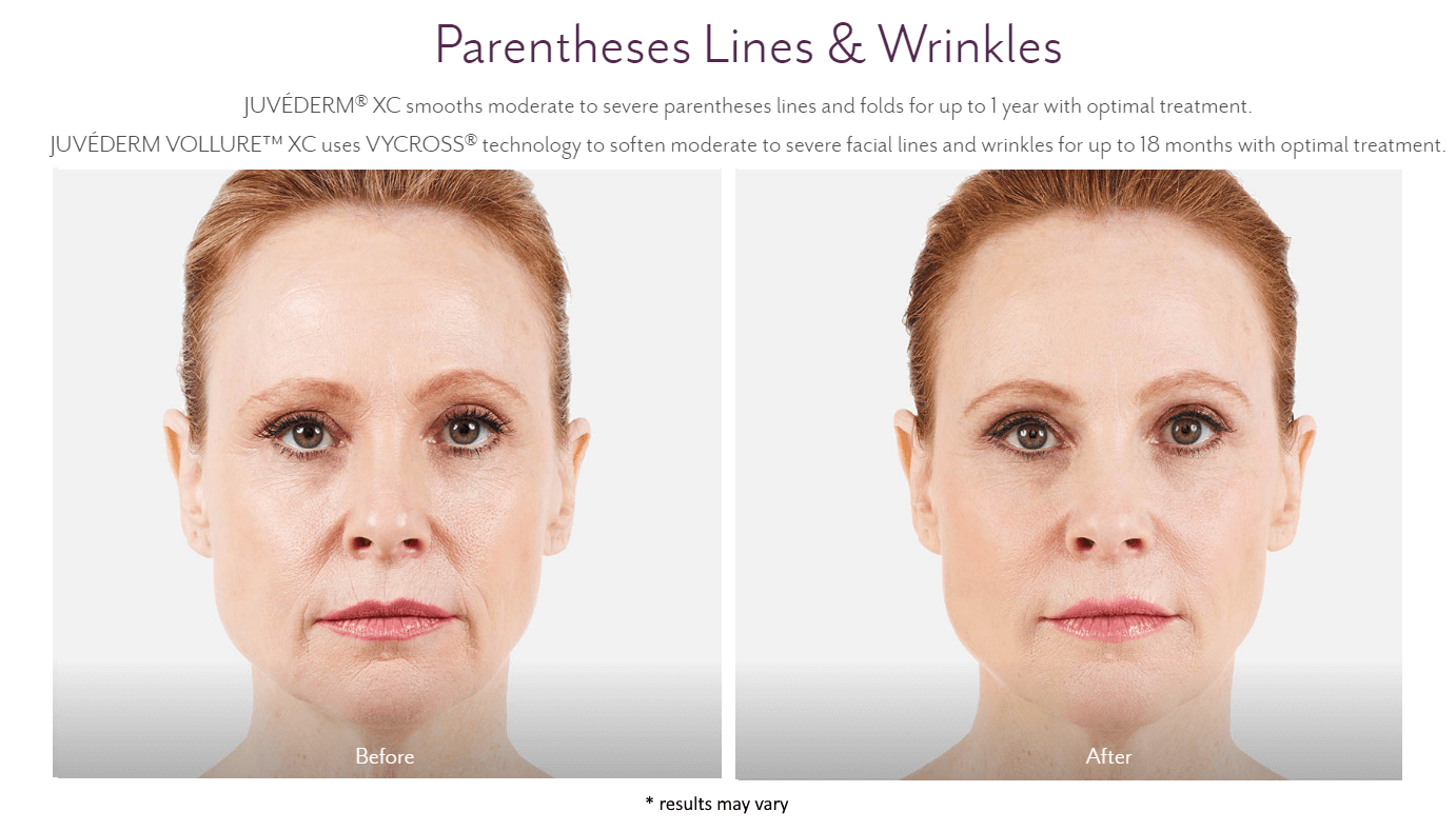 new-beauty-wellness-juvederm-before-and-after-3