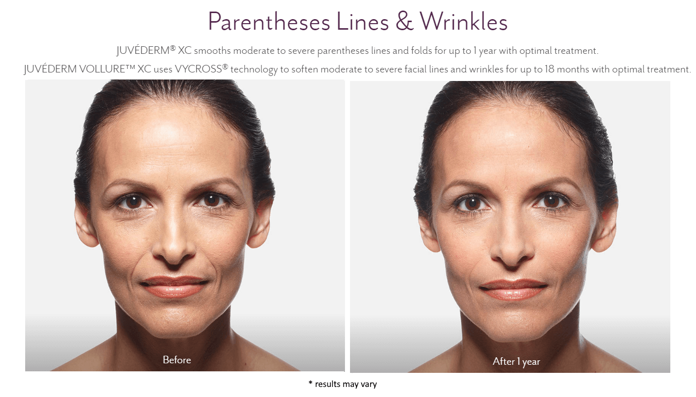new-beauty-wellness-juvederm-before-and-after-4