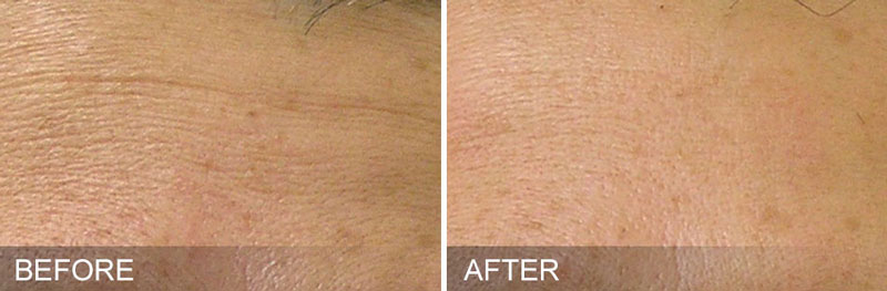 pg-hydrafacial-before-after-FineLines