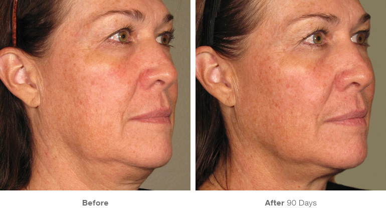 ultherapy-before-after-face20