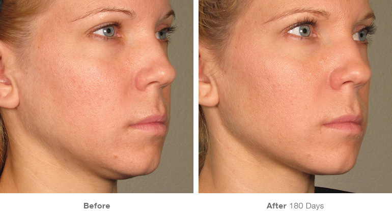 ultherapy-before-after-face23