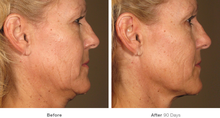 ultherapy-before-after-face24