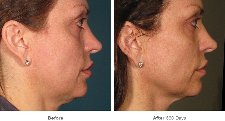 ultherapy-before-after-face3