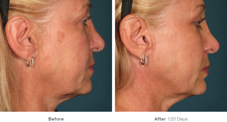 ultherapy-before-after-face5